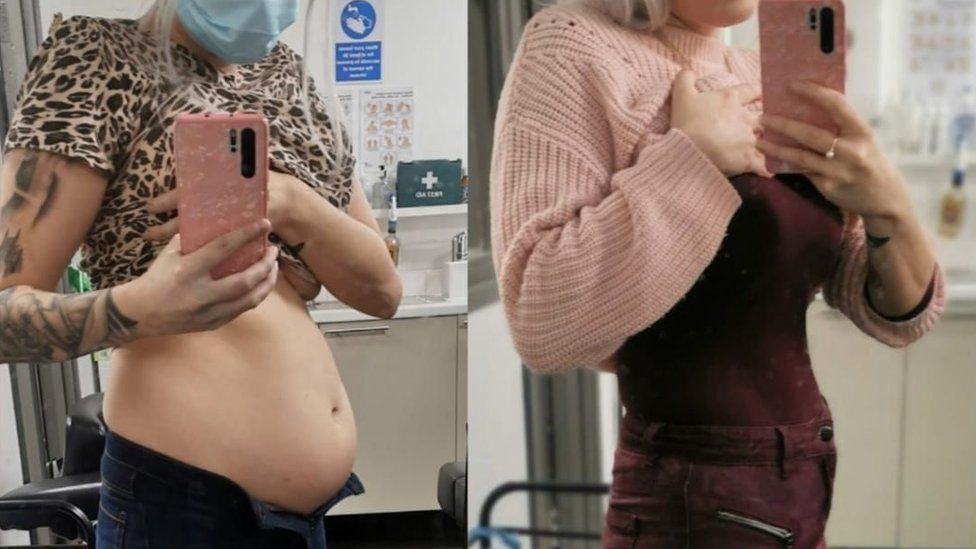 Comparison of bloating in the midriff
