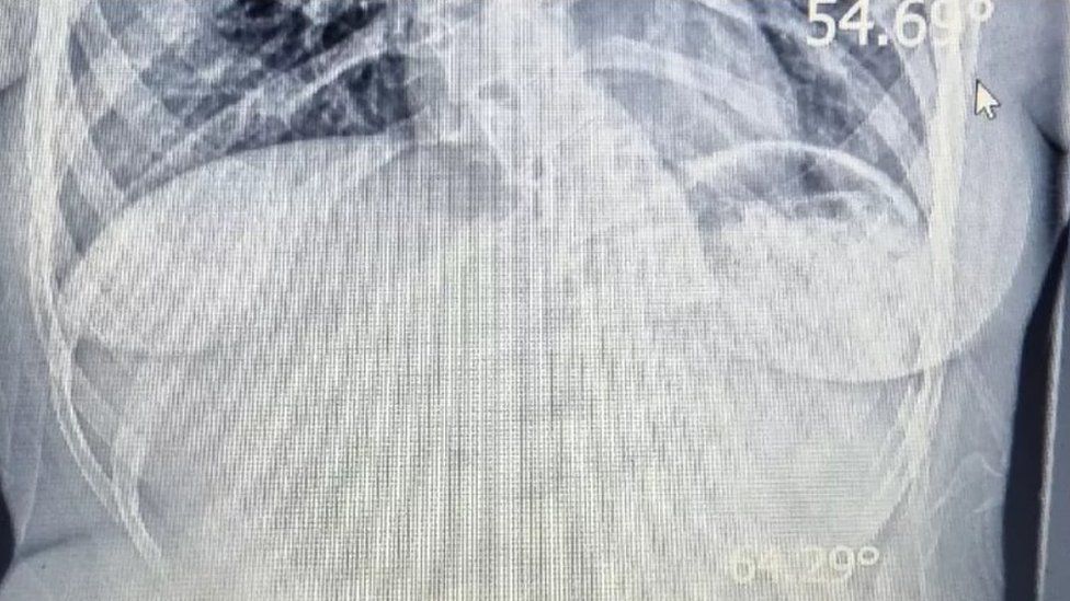 x-ray showing the curves