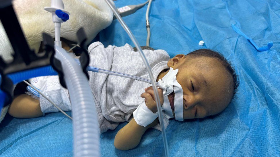 malnourished baby Nahed in kamal Adwan hospital, northern Gaza