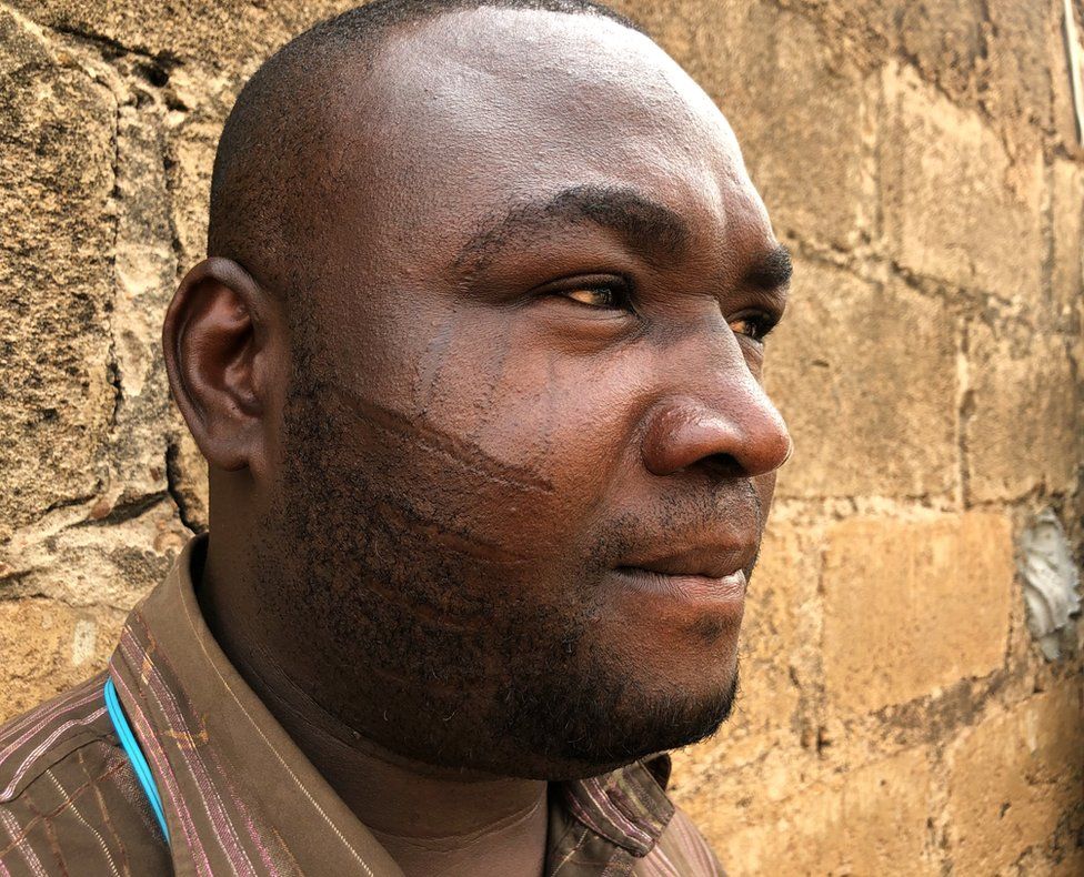 A man with scars on his face