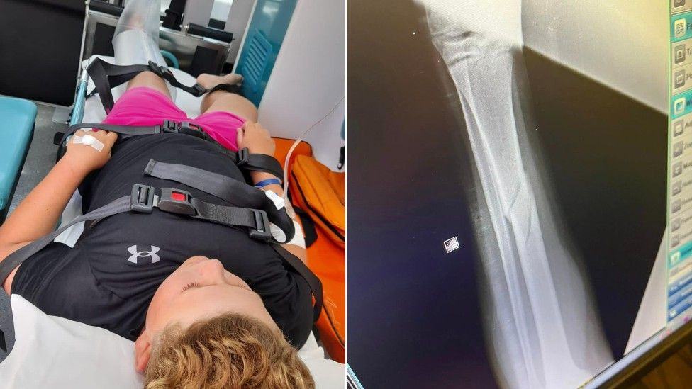 Vinnie in ambulance and x ray of break