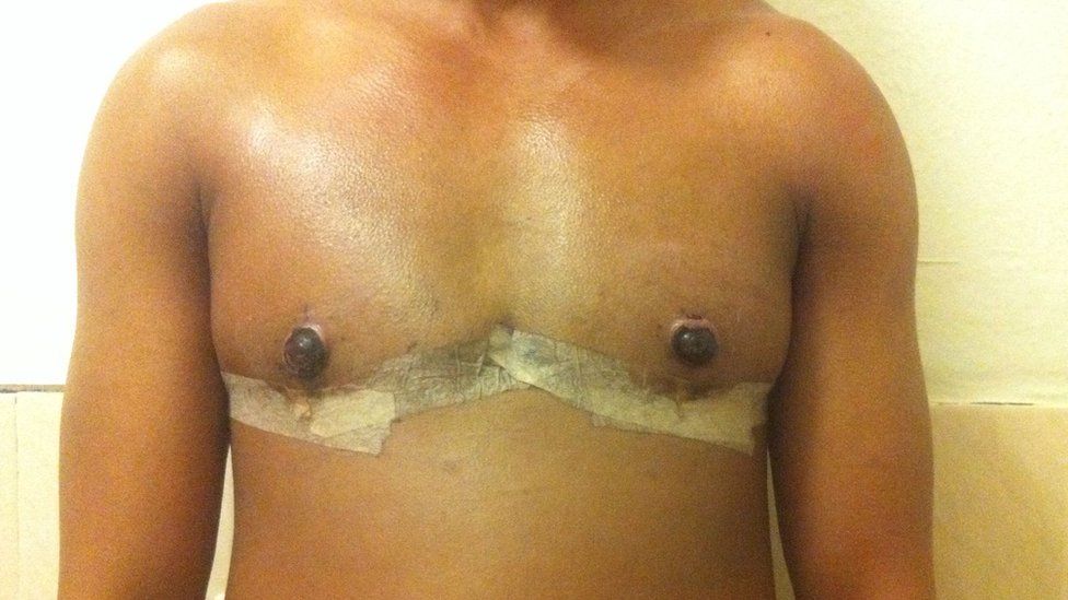 Romario Wanliss' chest with surgical tape on