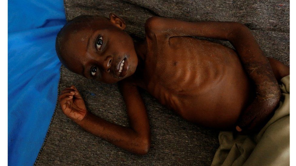 A malnourished child in Kasai