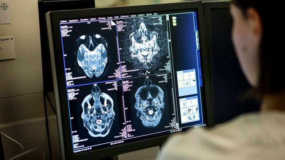 New unit for 'forgotten' patients with alcohol related brain damage ...