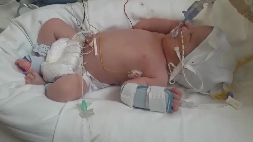 Baby with breathing tube and other wires attached