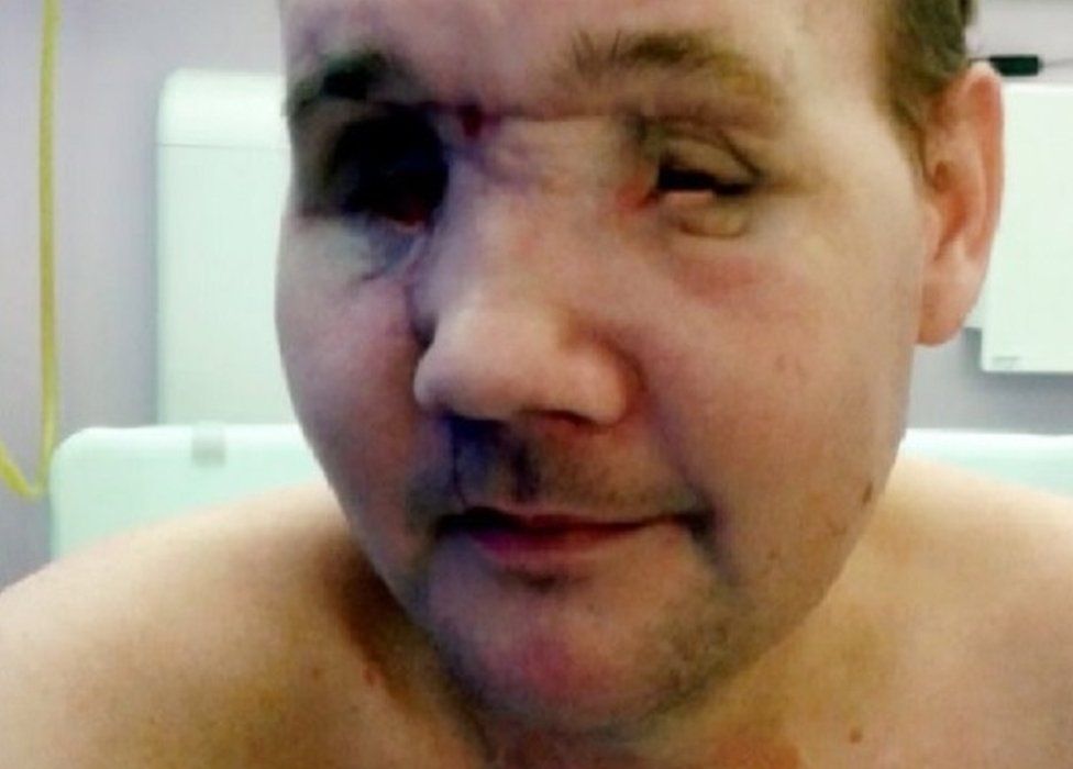 Andrew Foster lost his right eye and was blinded in the other