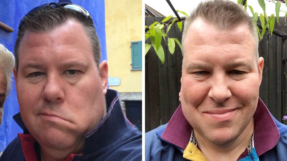 Krebspatient Daniel Kilty vor und nach der Operation.