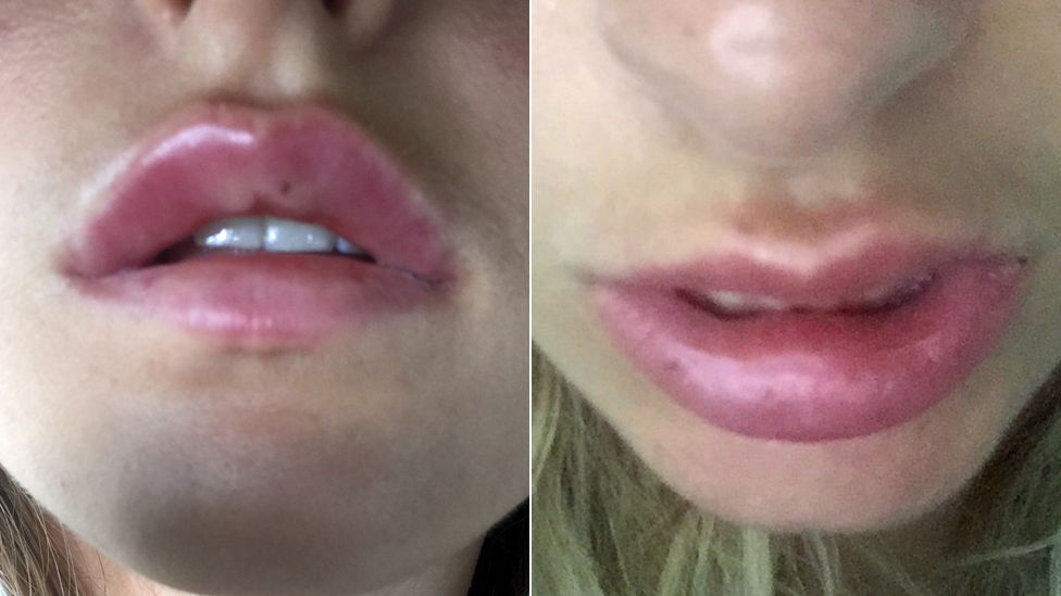 Tina's swollen lips