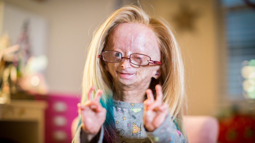 Youtuber Adalia Rose Dies Aged 15 From Genetic Condition Bbc News