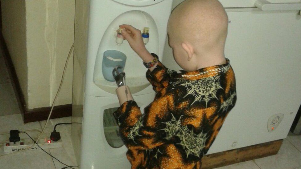 Albino child with prosthetic limb gets water
