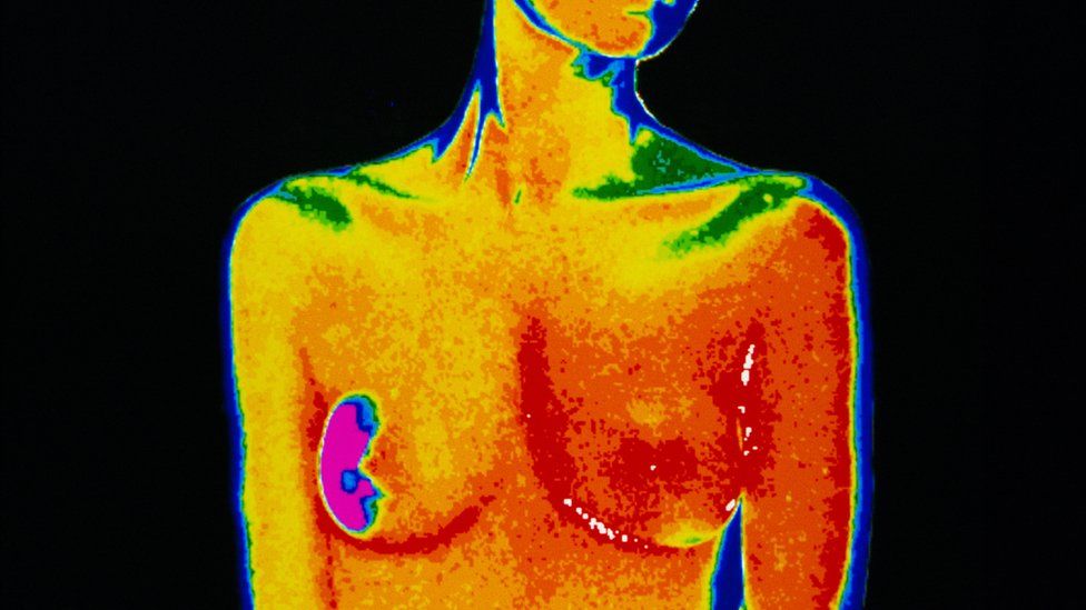 A scan of a woman with breast cancer