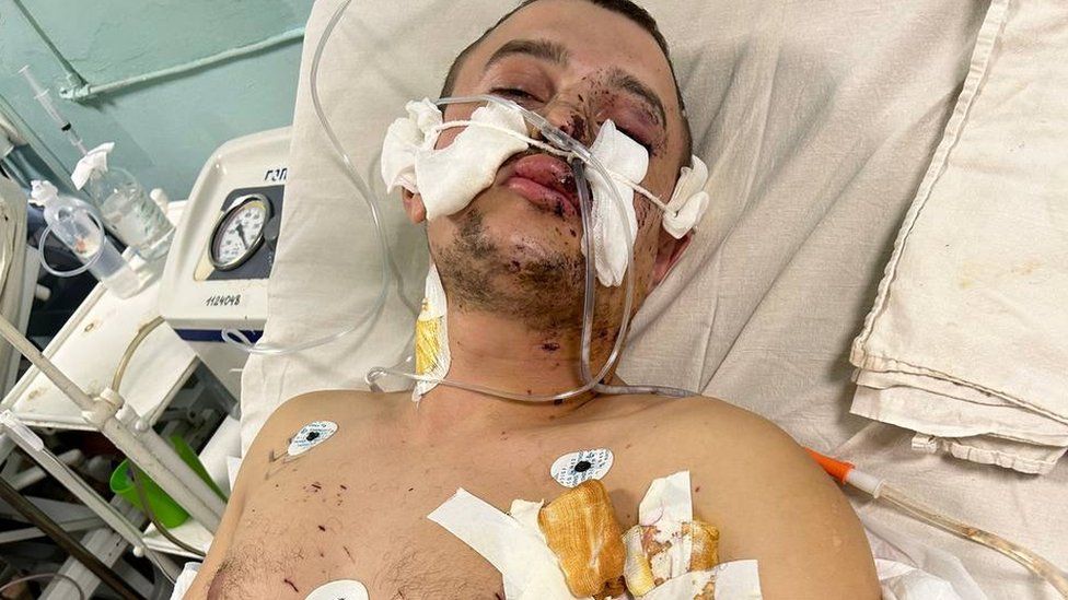 Serhiy lies in a hospital bed with bandages in his face and on his right upper body