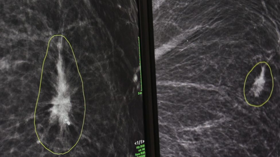 Two areas of concern circled on a mammogram by AI software