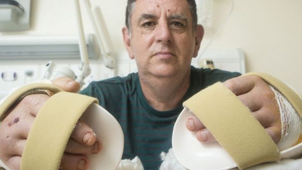 The UK's first double hand transplant recipient Chris King