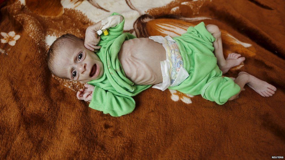 A malnourished child lies in a bed at a hospital in Yemen's capital, Sanaa (28 July 2015)