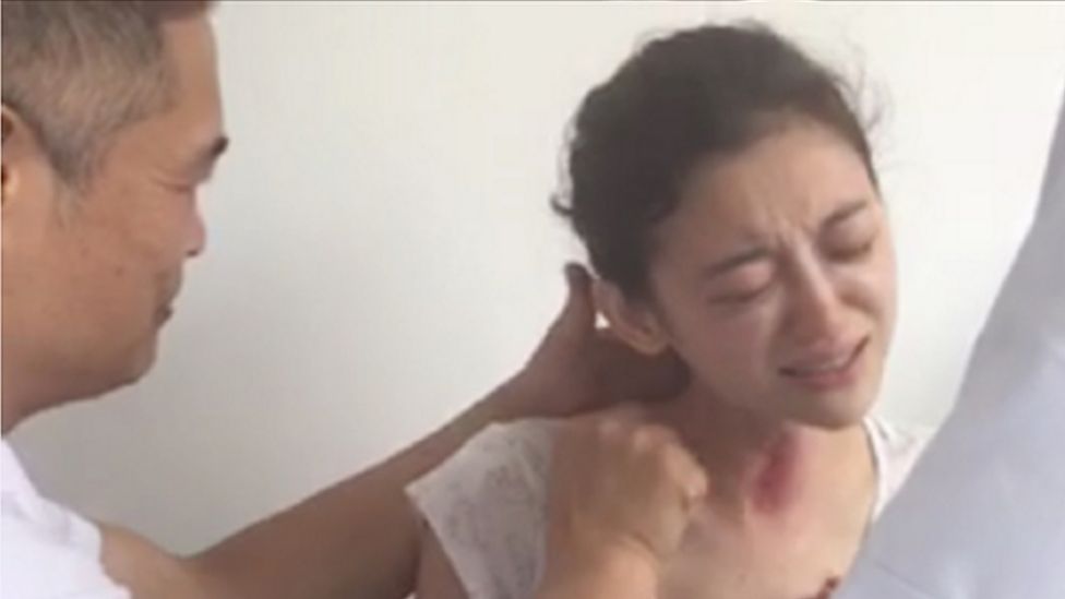 Picture of Xu Ting undergoing gua sha