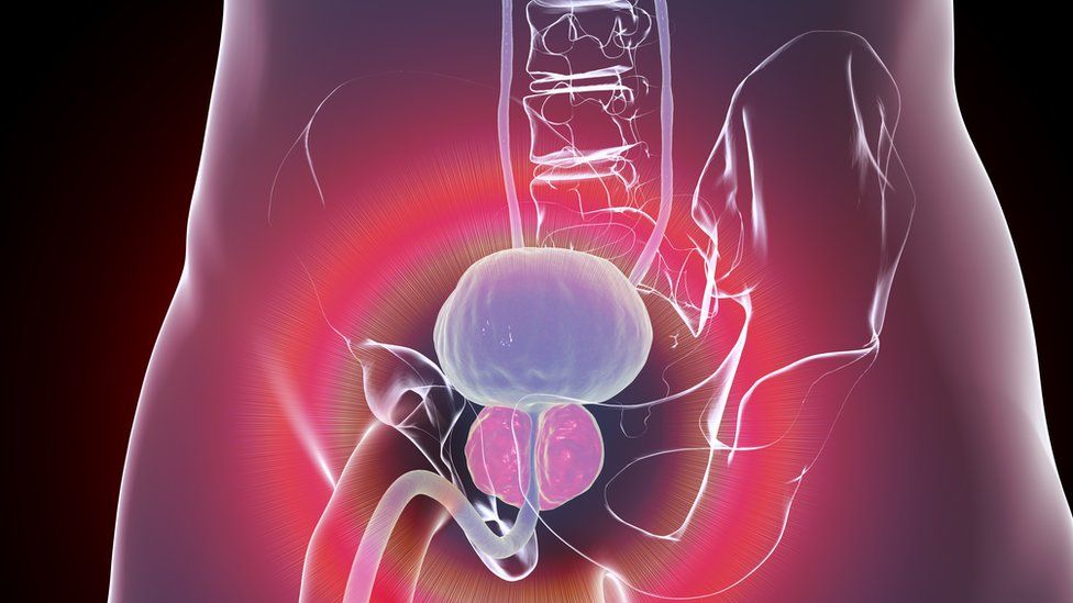 Enlarged prostate sitting below the bladder
