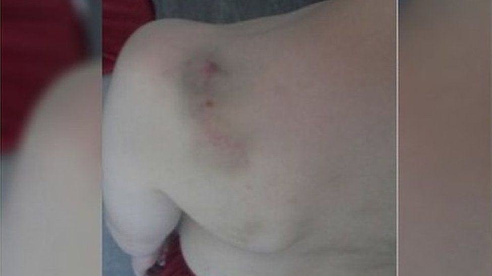 Bruises on Arthur's back