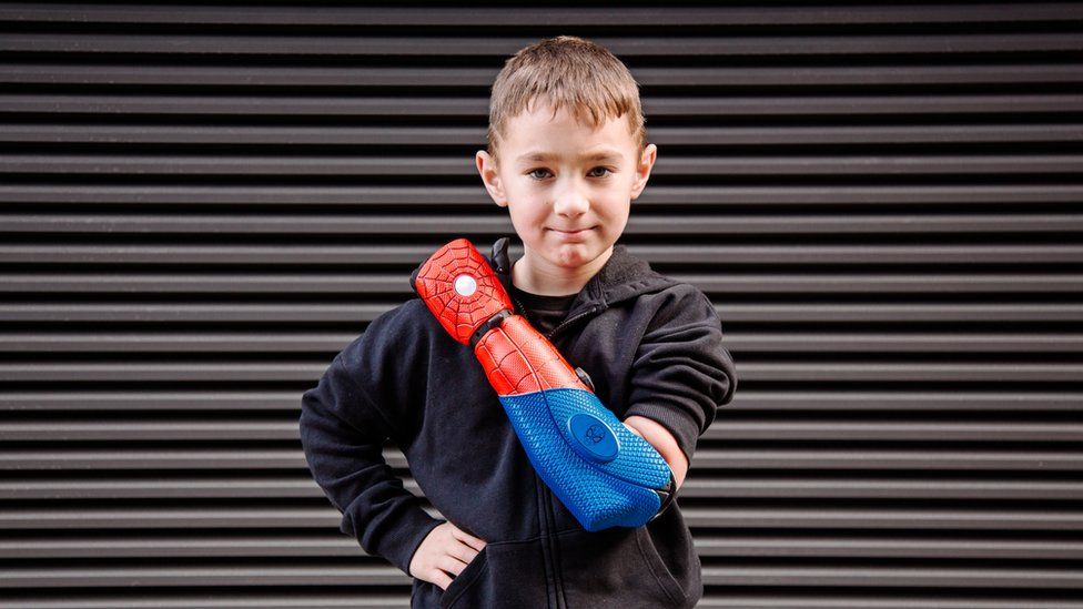 Kaden Taylor from Burnham-on-Sea with his new bionic arm