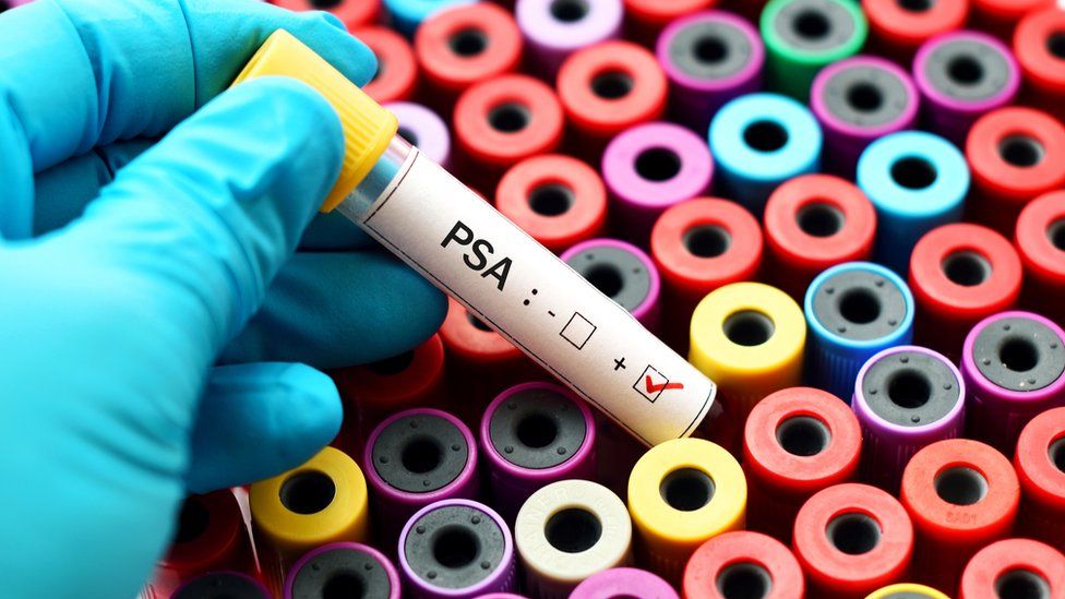 biopsia de próstata cómo hacer calculadora