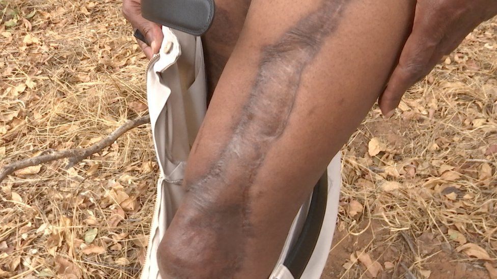 Frank Limbo's scar from an elephant scar