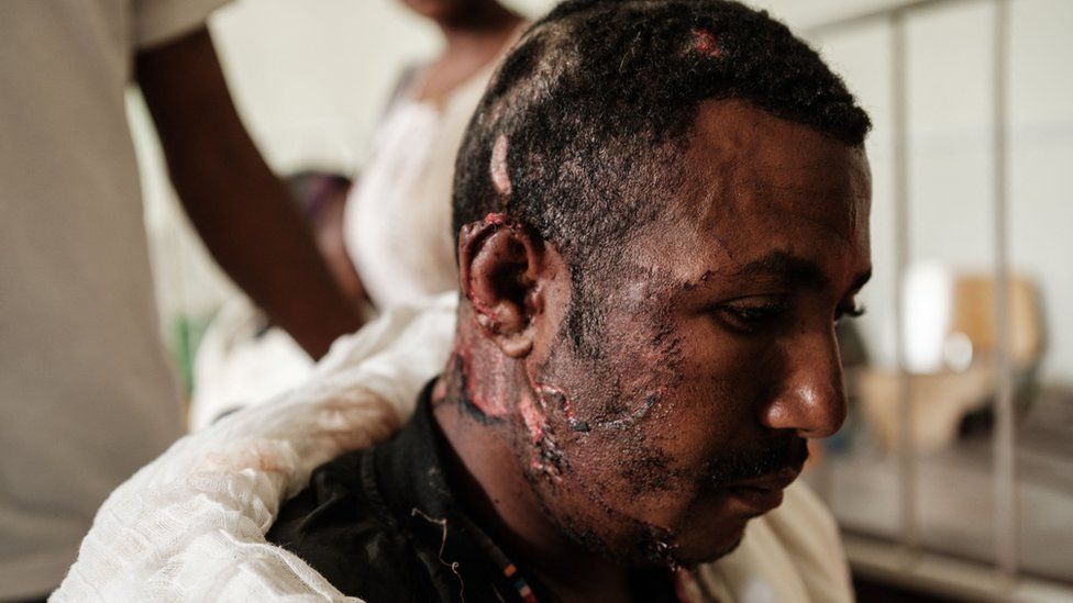 A man who was injured in Ethiopia's reported air strike is treated at Aider hospital in Mekelle, Ethiopia. Photo: 23 June 2021