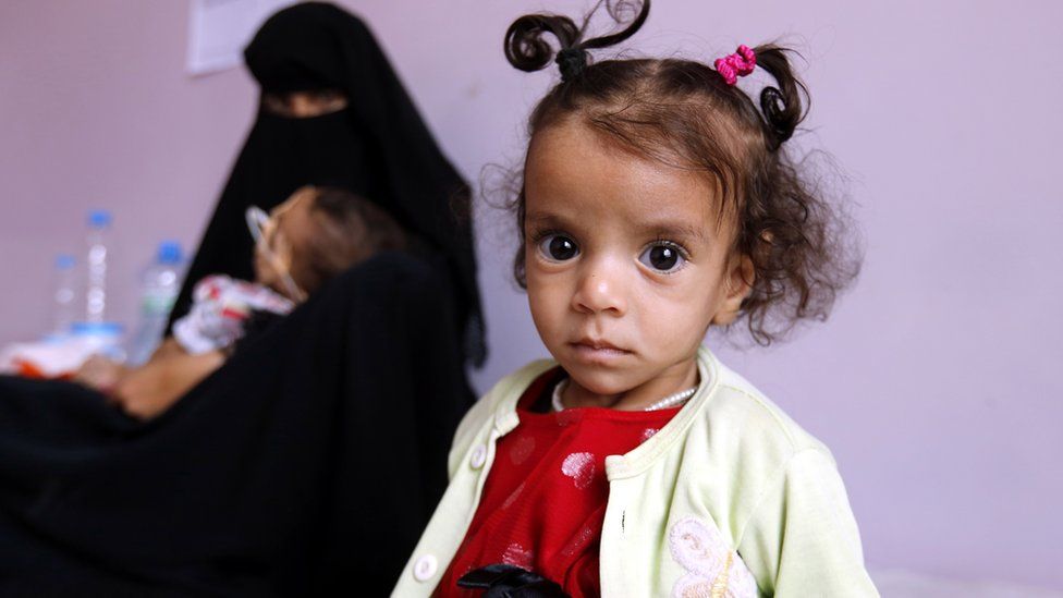 Malnourished child Hanin al-Watari, 10 months (R) sits on a bed as she receives treatment at the malnutrition treatment centre, in Sana'a, Yemen, 22 October