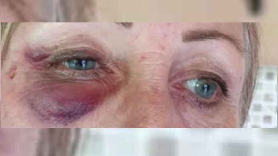 Bruised eyes of ambulance paramedic