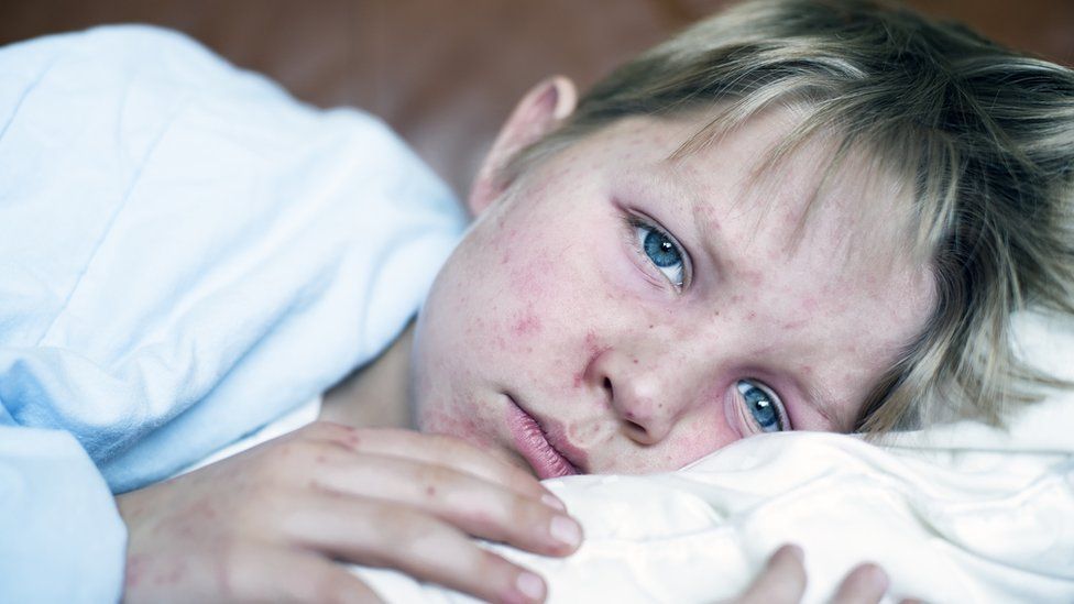 young boy with measles