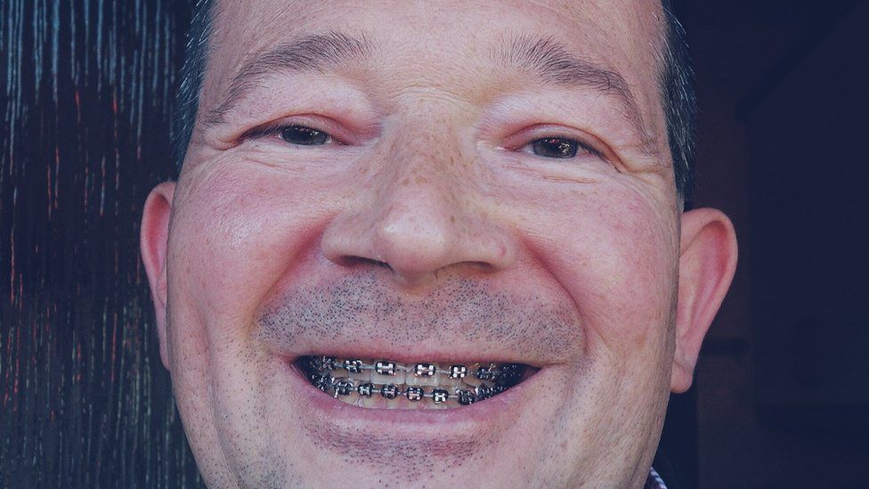 Neil Hillyard with braces