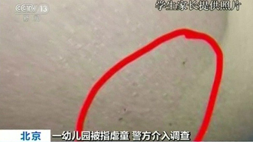 Picture of needle marks on child allegedly abused at a RYB Education nursery in Beijing