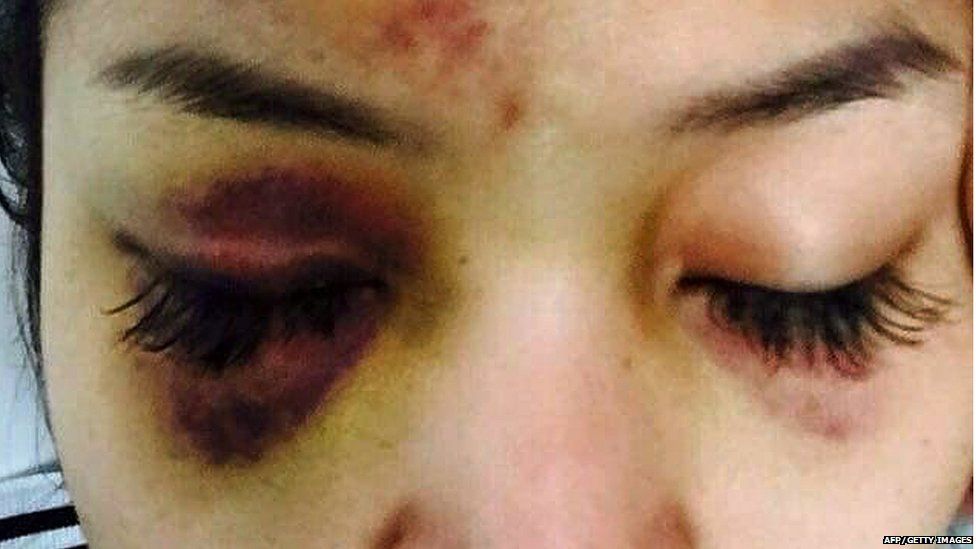 This recent undated handout photo released to AFP on July 16, 2015 shows a wound on the face of popular Cambodian television star Ek Socheata, better known by her stage name SaSa, who was attacked by a tycoon in Phnom Penh.
