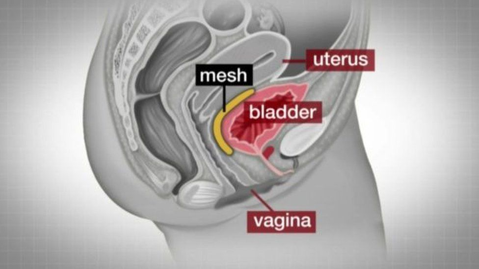 diagram of vaginal mesh implant