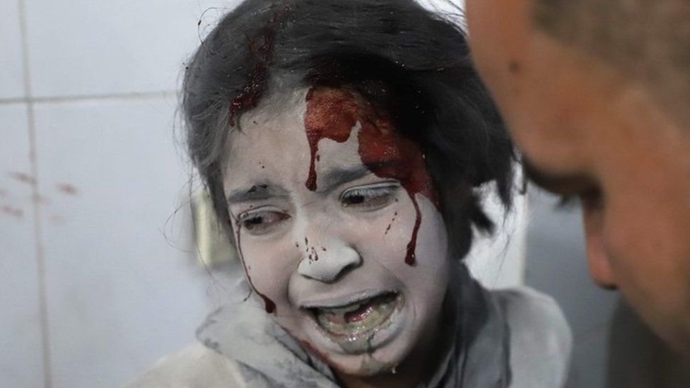 A Syrian girl receives treatment in the rebel-held enclave of Eastern Ghouta on March 7, 2018.