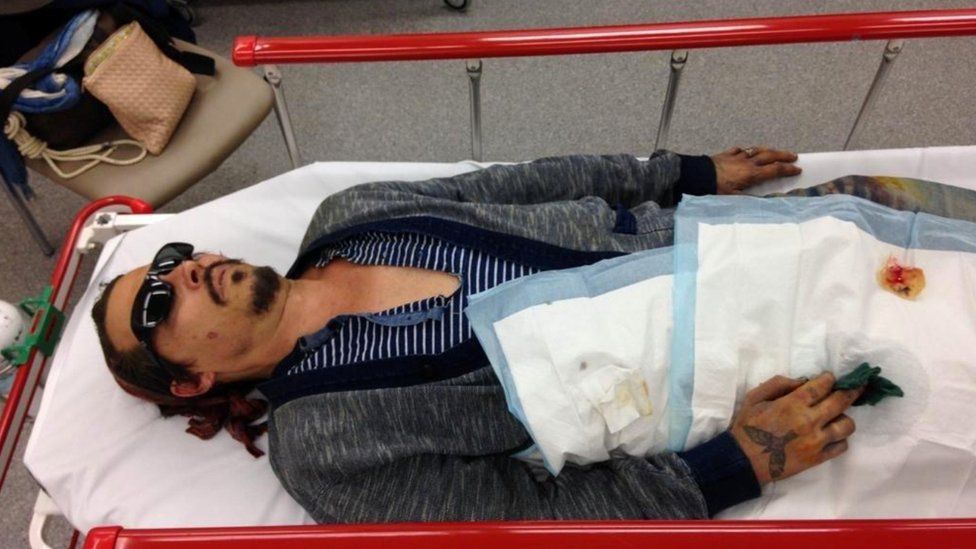 Johnny Depp lies on a stretcher with an injured finger