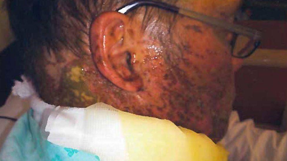 Injuries sustained by Wayne Ingold following an attack in Bramble Road, Witham