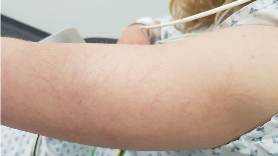 Keraunographical marks on Isobel's arm