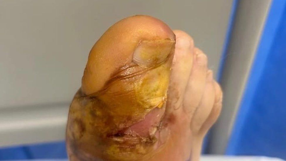 Colin Blake's toe turned red and swollen while on holiday