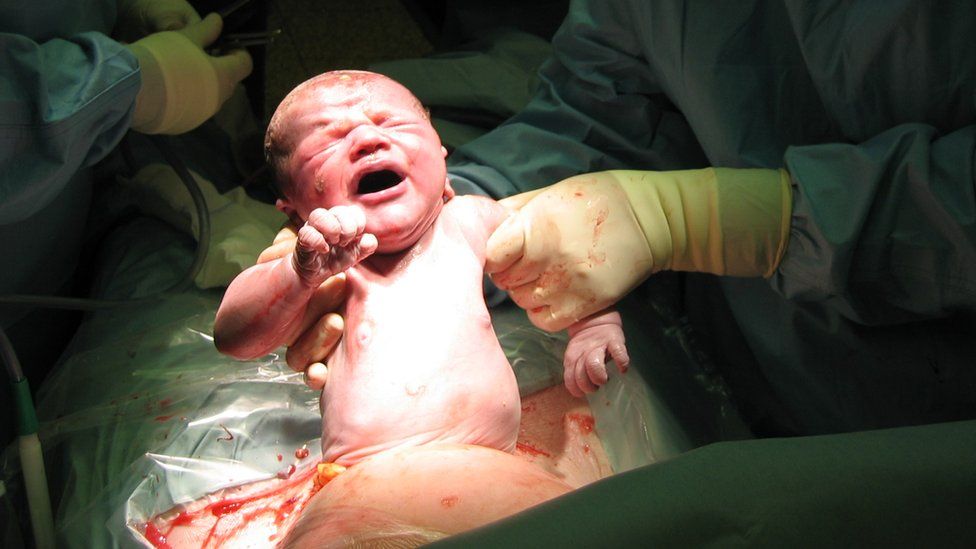 baby born by caesarean