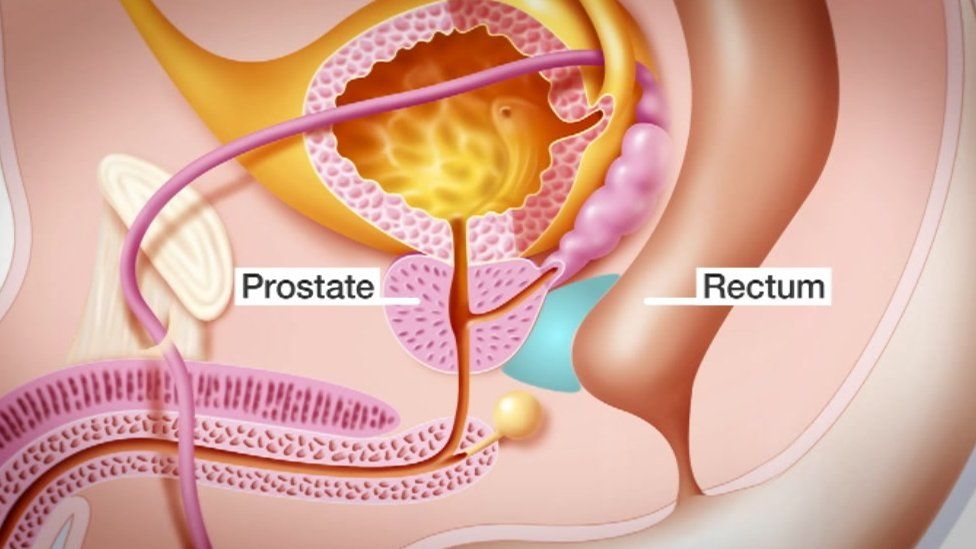 Diagram showing prostate gland with gel implant