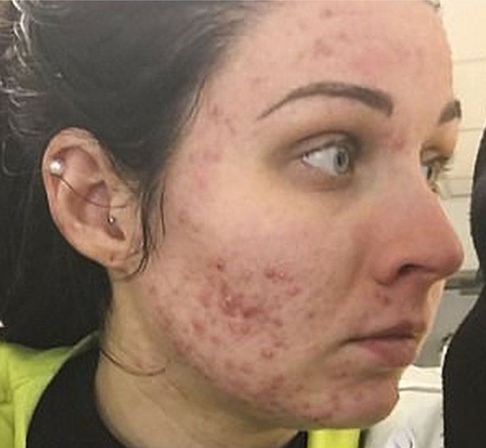 How People with Facial Acne Scars are Perceived in Society: an Online Survey