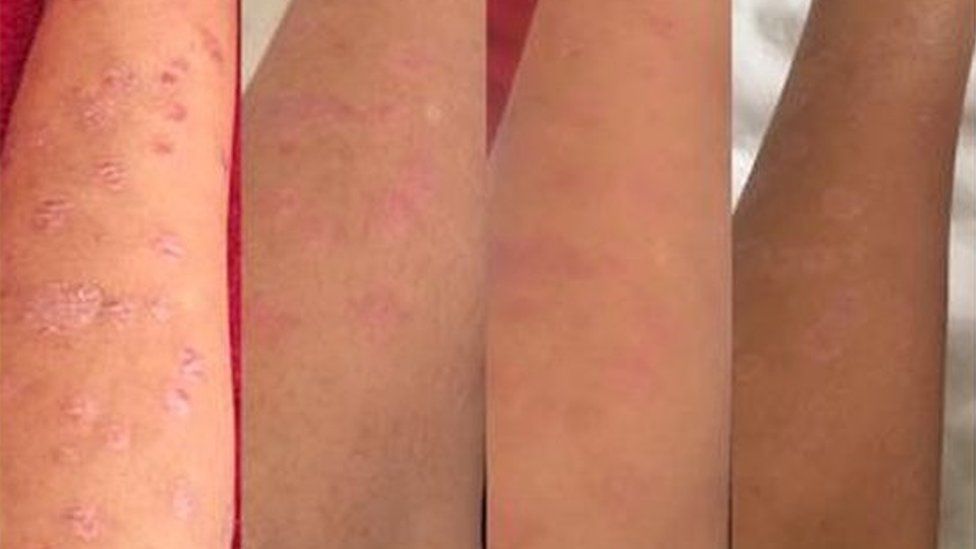 psoriasis flare up in summer)