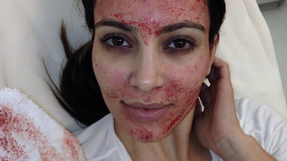 A selfie of Kim Kardashian post-vampire facial, in which her face appears to be dotted with blood