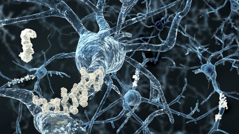 Neurons with amyloid plaques in Alzheimer's disease