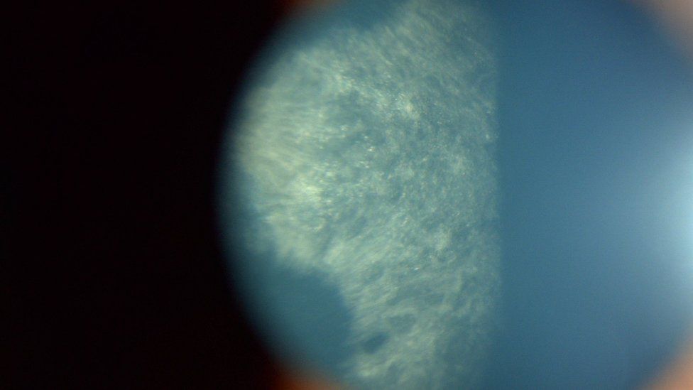 Cataract close up