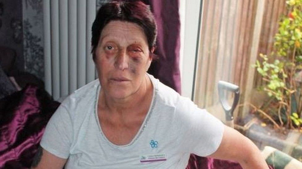 Woman with eye injuries after being attack