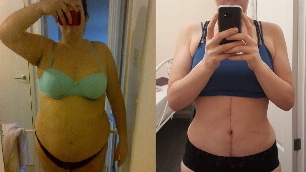 On the left Abby at her biggest weight of 20 stone and on the left after she has had the surgery to remove her excess skin