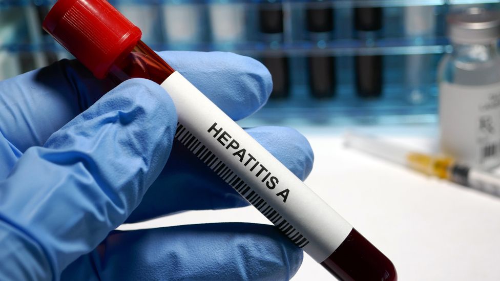 Hepatitis A test