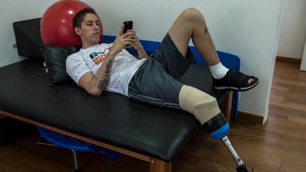 A man with an amputated leg is pictured resting during rehab class