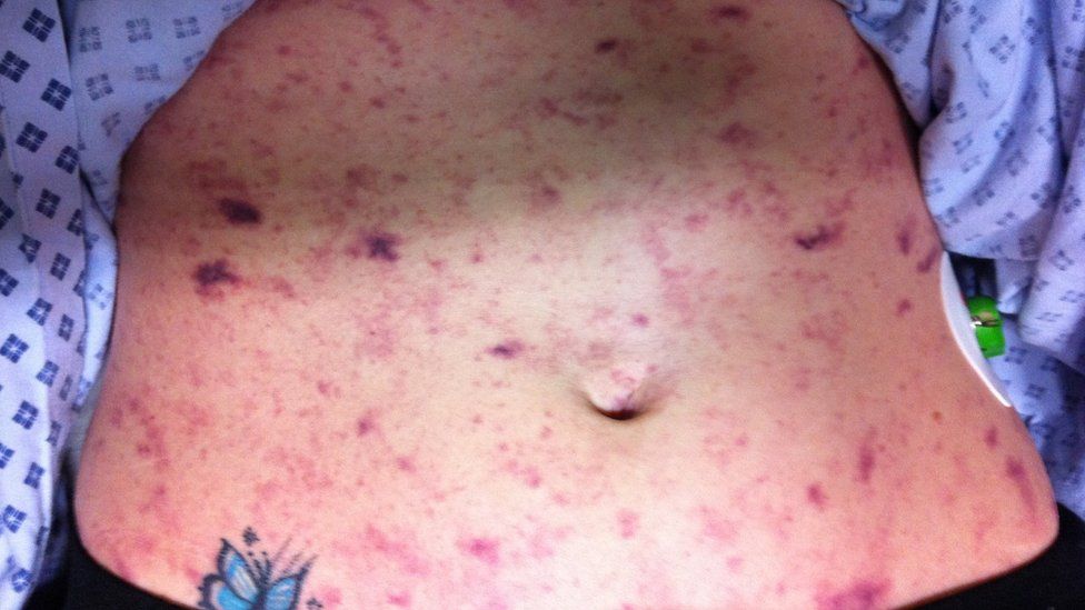 Meningitis rash